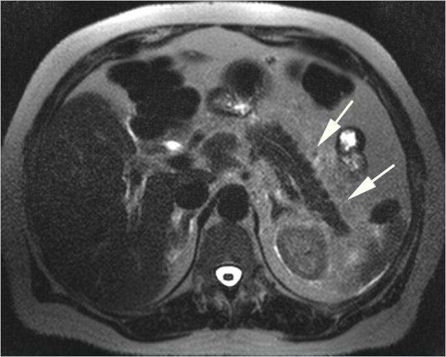 Imaging Assessment Of Etiology And Severity Of Acute Pancreatitis ...